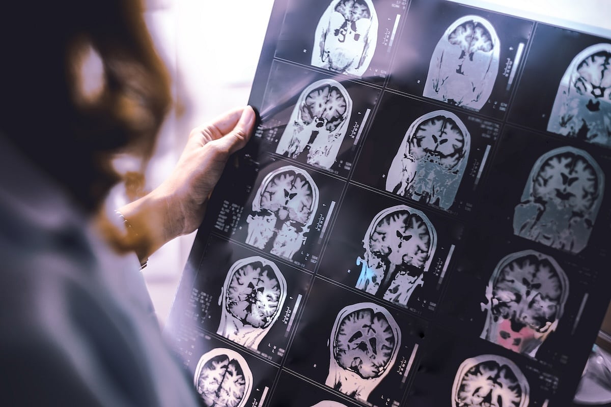IA detecta lesiones cerebrales invisibles en esclerosis múltiple: implicaciones para diagnóstico clínico